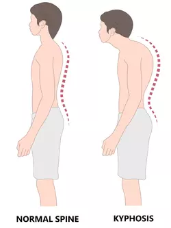 Kyphosis-scaled.webp