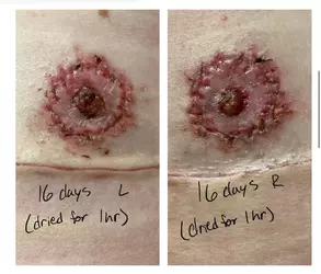 16-days-post-op-are-my-nipples-okay-v0-loxsaqqv1cdf1.webp