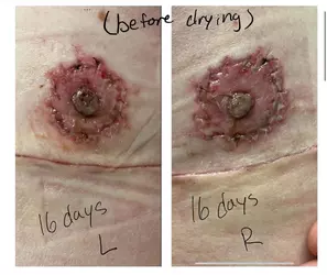 16-days-post-op-are-my-nipples-okay-v0-vbux6rqv1cdf1.webp