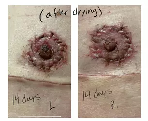 16-days-post-op-are-my-nipples-okay-v0-exawirqv1cdf1.webp