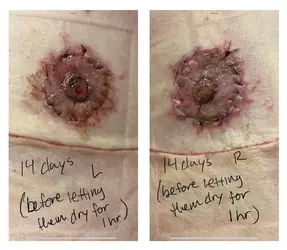 16-days-post-op-are-my-nipples-okay-v0-och4rrqv1cdf1.webp