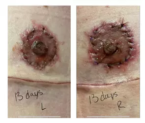 16-days-post-op-are-my-nipples-okay-v0-8tqqqrqv1cdf1.webp