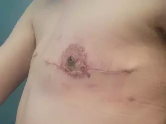 about-3-weeks-post-op-v0-wad0juq2hcdf1.webp