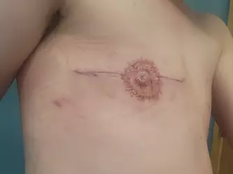 about-3-weeks-post-op-v0-2e47e9n2hcdf1.webp