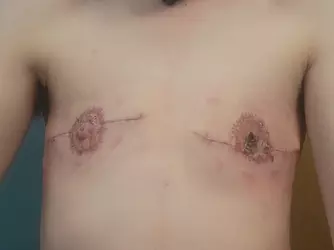 about-3-weeks-post-op-v0-xkpgx0j2hcdf1.webp