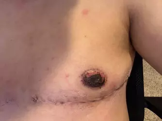 yellowish-fluid-has-collected-between-the-nipple-and-the-v0-rqanxgzvljdf1.webp