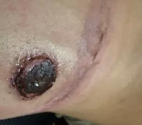 yellowish-fluid-has-collected-between-the-nipple-and-the-v0-qdzep9zvljdf1.webp