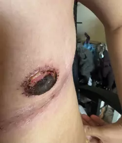 yellowish-fluid-has-collected-between-the-nipple-and-the-v0-of296ezvljdf1.webp