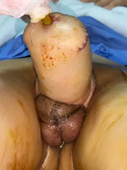 4-days-post-op-from-stage-1-phallo-in-thailand-v0-ndf342vg8zdf1.webp