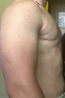 nipple-revision-opinions-wanted-v0-danu71u1un8f1.webp