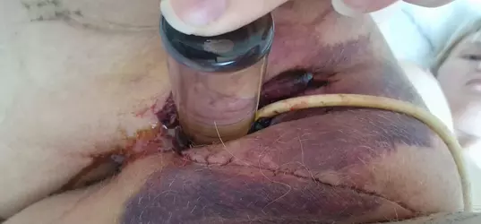 my-healing-progress-after-vaginoplasty-in-spain-warning-v0-6ogr4vwh27ef1.webp