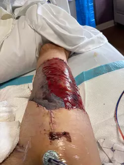 day-5-post-op-alt-stage-1-phallus-ul-and-nerve-grafting-dr-v0-wig0sbwk6ief1.webp