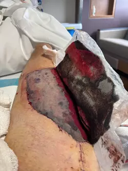 day-5-post-op-alt-stage-1-phallus-ul-and-nerve-grafting-dr-v0-b94vjbwk6ief1.webp