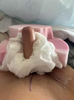 day-5-post-op-alt-stage-1-phallus-ul-and-nerve-grafting-dr-v0-za4xhawk6ief1.webp