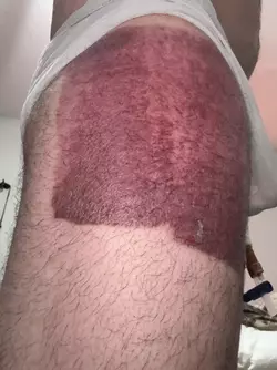 5-week-update-fistula-concerns-v0-44umhve04off1.webp