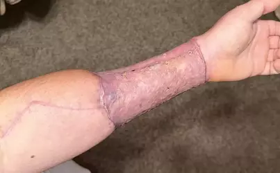 5-week-update-fistula-concerns-v0-1pt16xe04off1.webp