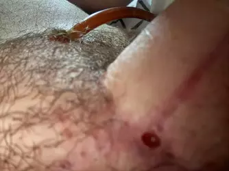 5-week-update-fistula-concerns-v0-9owcsye04off1.webp