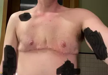 pre-op-7weeks-post-op-breast-reduction-top-surgery-v0-7wkwphkzh7hf1.webp