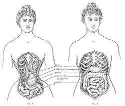 medical-crimes-of-the-corset-1908-wellcome-images.jpg