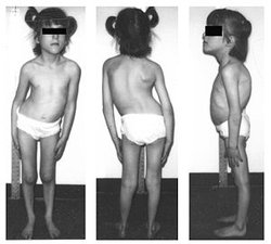 300px-Kyphoscoliosis_hereditary_sensory_autonomic_neuropathy_III.jpg