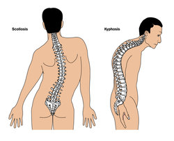 abnormal-curvature-of-the-spine.jpeg