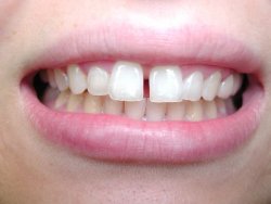 gapbetweenfrontteeth.jpg
