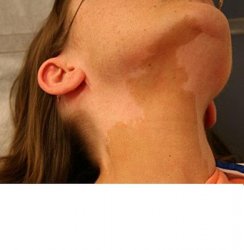 mccunealbrightsyndrome7.jpg