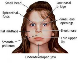 Fetal-Alcohol-Syndrome.jpg