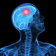 McCain's Brain Tumor
