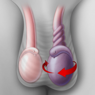 Testicular Torsion