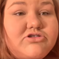 Amber's Lymphedema