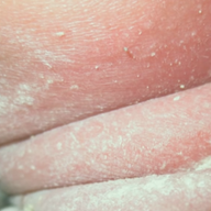 Skin Fold Odor