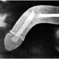 Penile Fracture