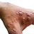 Smallpox Dox
