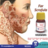 Scrofula